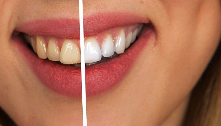 Nakładkowe wybielanie zębów – sprawdzony sposób na śnieżnobiały uśmiech