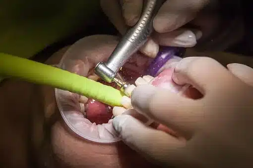 Endodoncja w Łodzi – leczenie endodontyczne