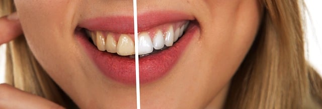 Dlaczego warto zdecydować się na wybielanie zębów?